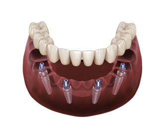Full dental arch illustration